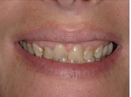Smile Gallery in Cortland, OH. Dr. Joseph D. Bedich, Dr. Josh Fromel. The Center for Progressive Dentistry