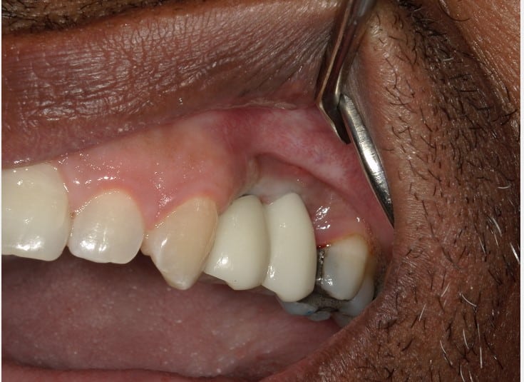 Smile Gallery in Cortland, OH. Dr. Joseph D. Bedich, Dr. Josh Fromel. The Center for Progressive Dentistry
